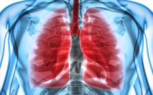 Pneumothorax