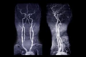 Sténose carotidienne