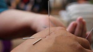 acupuncture