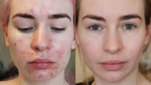 Roaccutane
