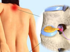 protrusion discale